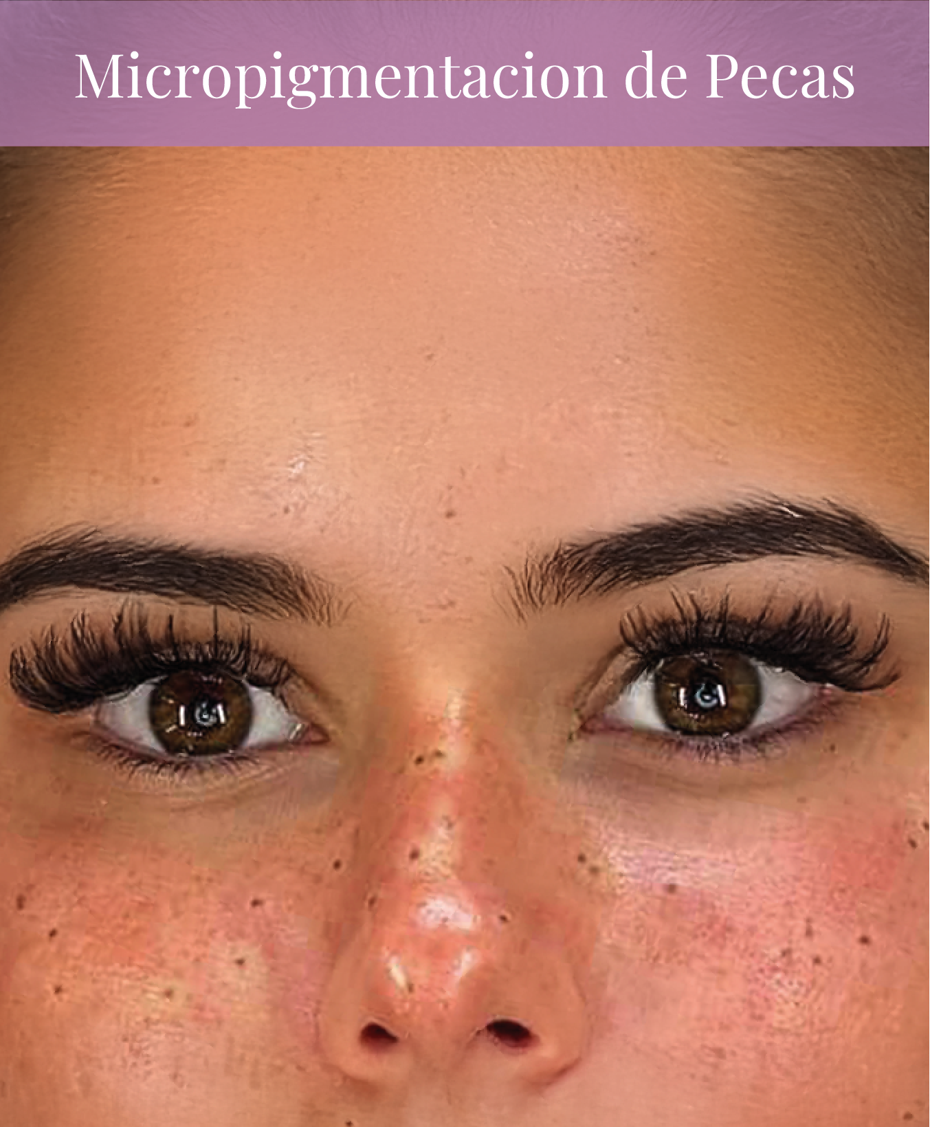 Micropigmentacion pecas